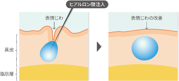 ヒアルロン酸注入