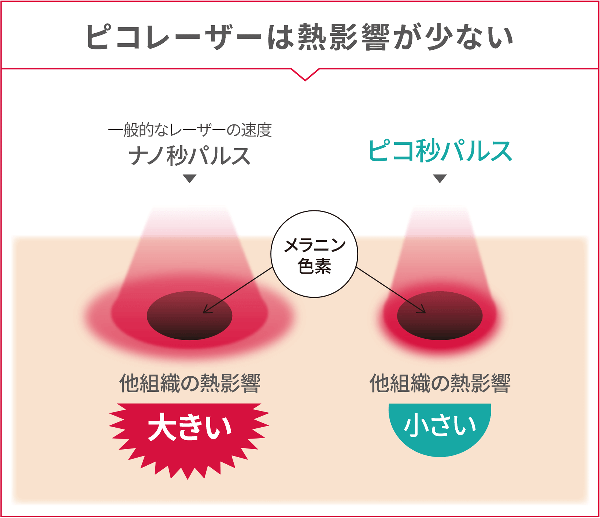 ピコレーザーは熱影響が少ない
