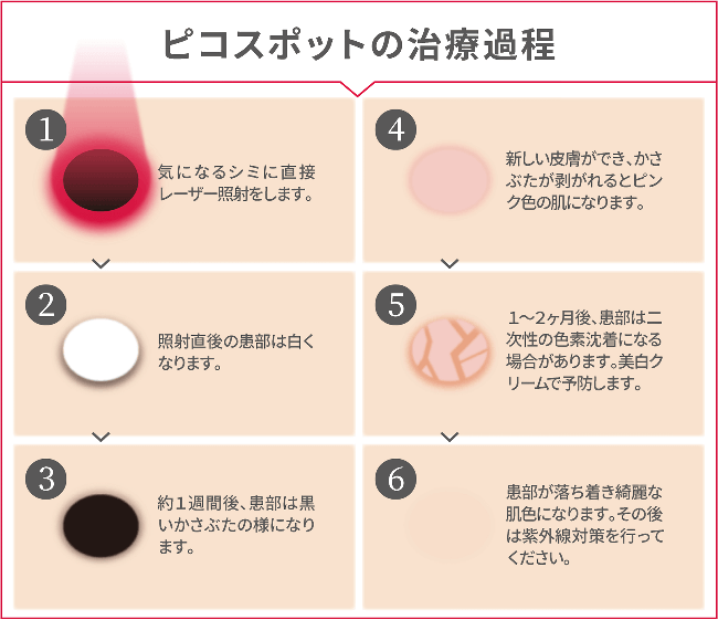 ピコスポットの治療過程