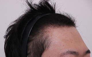東京にある自毛植毛の毛＆毛クリニックの症例02