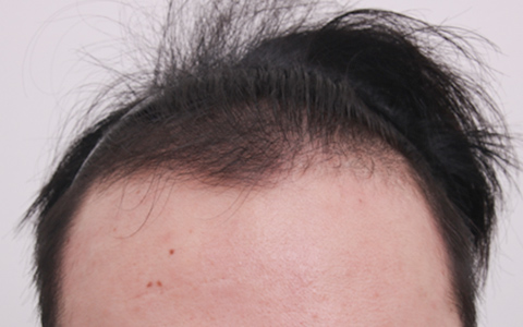 東京にある自毛植毛の毛＆毛クリニックの症例写真