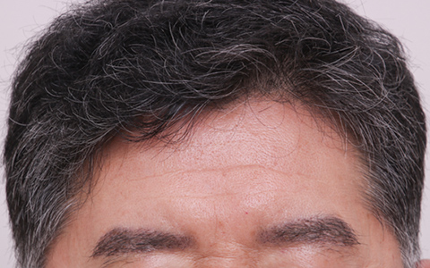 東京にある自毛植毛の毛＆毛クリニックの症例写真