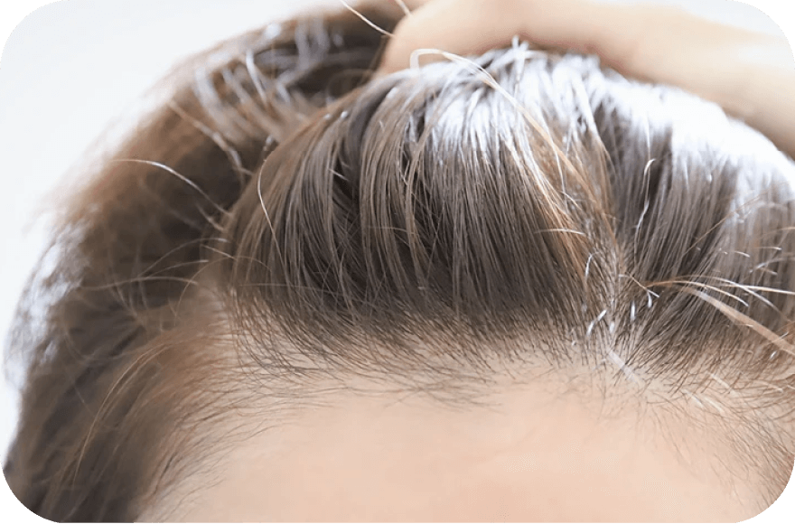 ヘアラインの生え際を手で押さえている女性